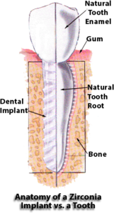 Anatomy of a Zirconia Implants vs. a Tooth diagram