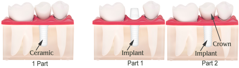 Zirconia dental implant diagram