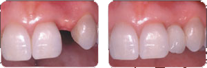 Before and after photo of a dental implant