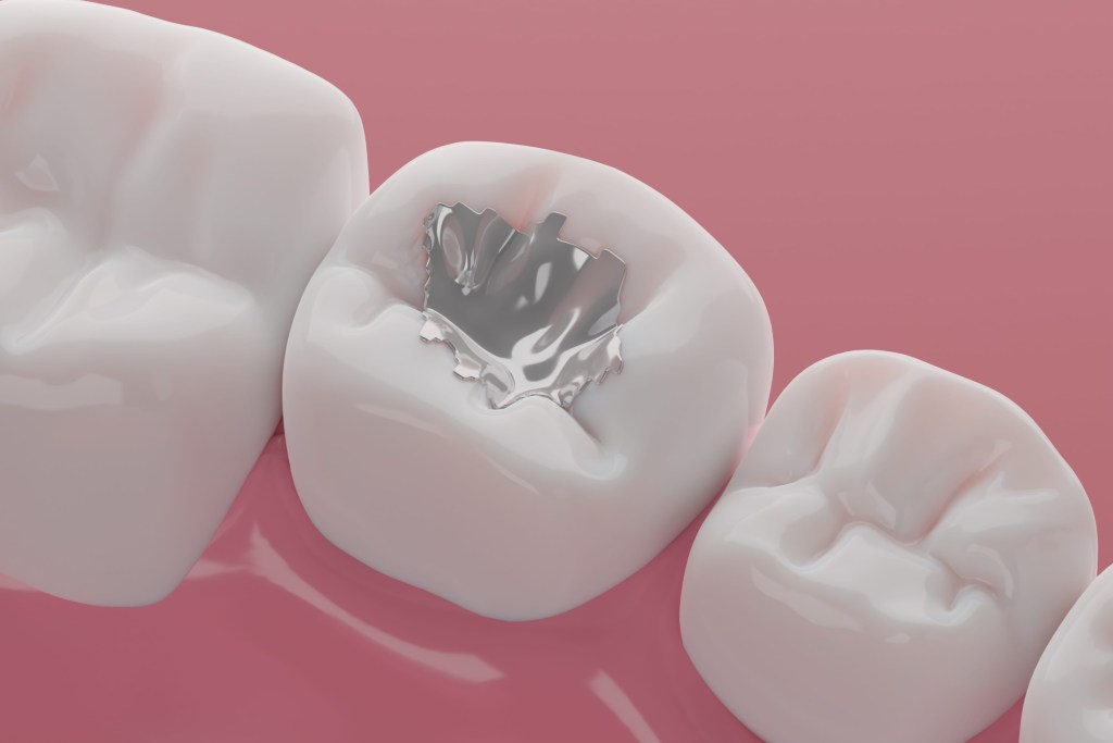 teeth coating silver amalgam filling